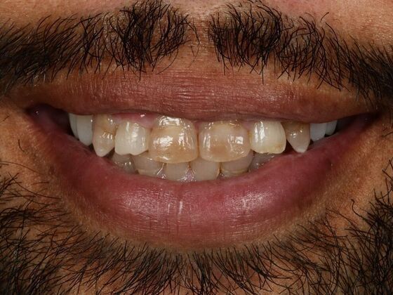 Porcelain Veneers: Vien - Before