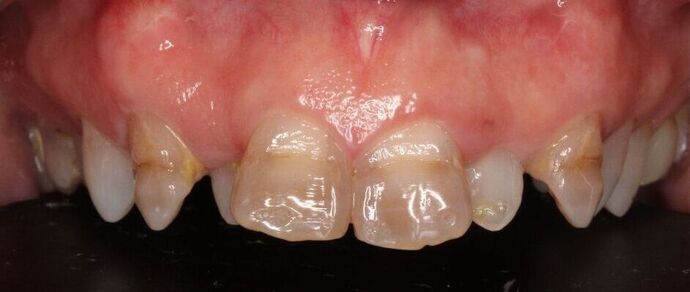 Porcelain Veneers: Vien - Before