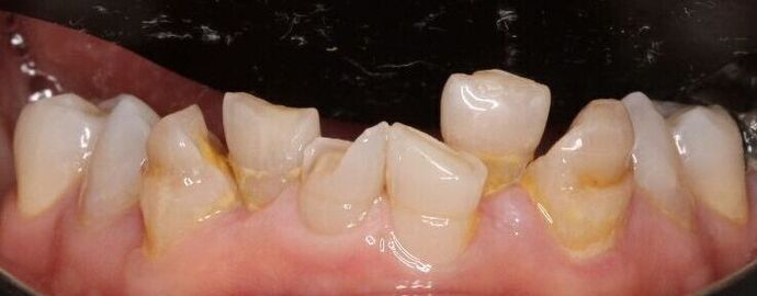 Porcelain Veneers: Vien - Before