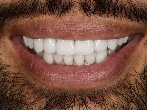 Porcelain Veneers: Vien - After