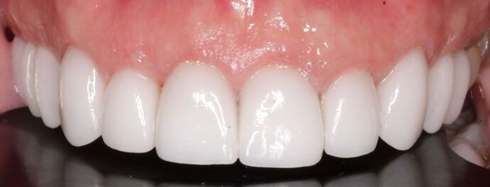 Porcelain Veneers: Vien - After
