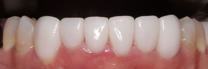 Porcelain Veneers: Vien - After