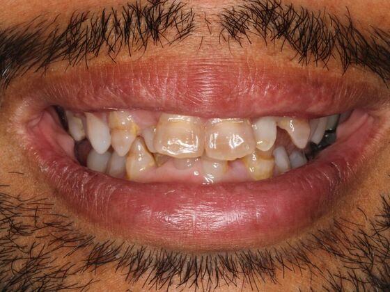 Porcelain Veneers: Vien - Before