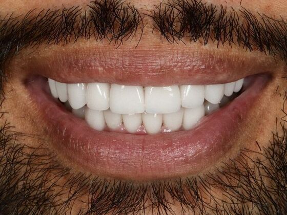 Porcelain Veneers: Vien - After