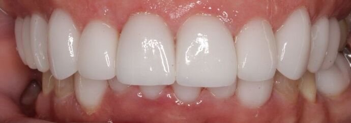 Porcelain Veneers: Vien - After