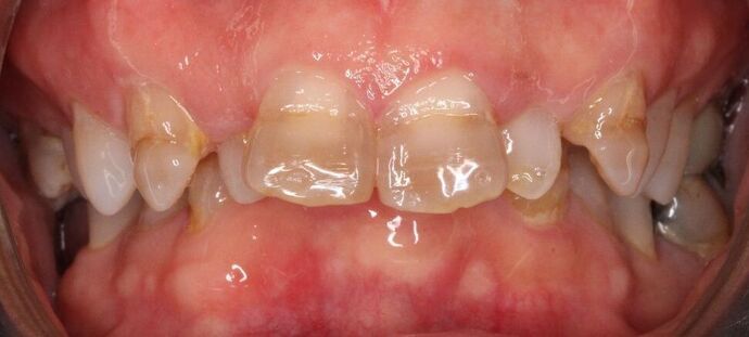 Porcelain Veneers: Vien - Before