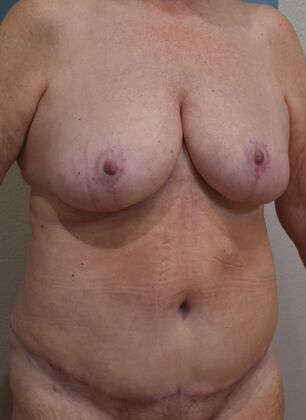 Mommy Makeover: Case 322 - After