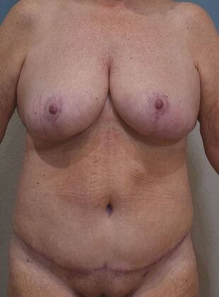 Mommy Makeover Case 322 - After