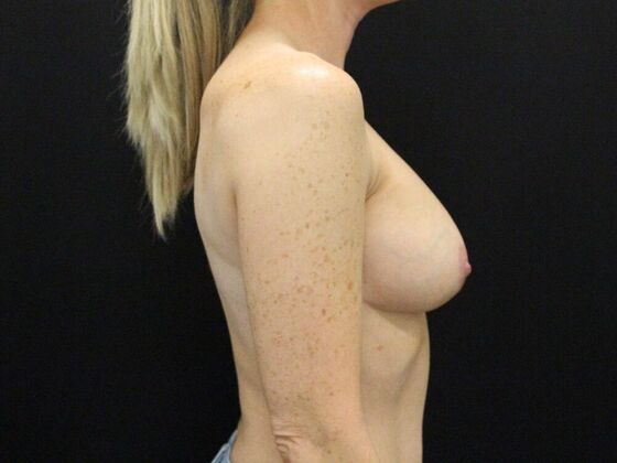 Breast Augmentation Exchange/Revision: Case 24 - Before