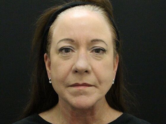 Face & Neck Lifts: Case 48 - After