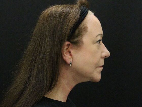 Face & Neck Lifts: Case 48 - After