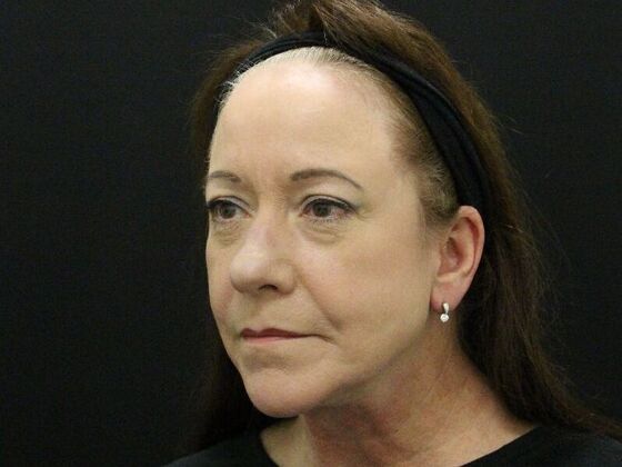 Face & Neck Lifts: Case 48 - After