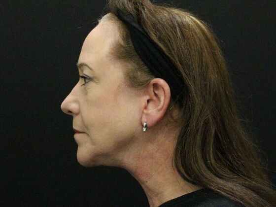 Face & Neck Lifts: Case 48 - After