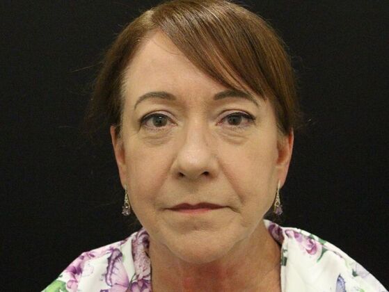 Face & Neck Lifts: Case 48 - Before