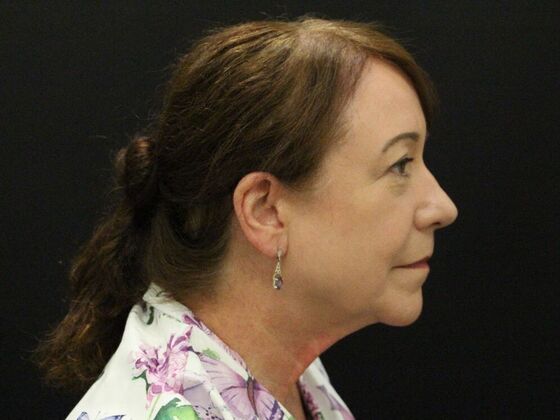 Face & Neck Lifts: Case 48 - Before