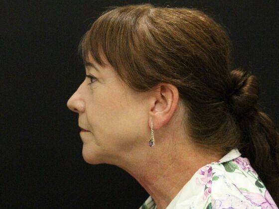 Face & Neck Lifts: Case 48 - Before