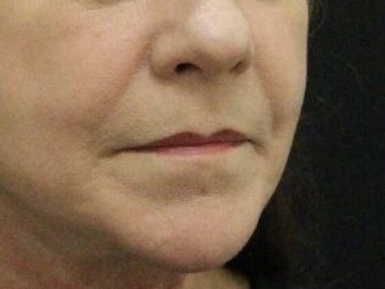 Non-Surgical: Case 11 - After