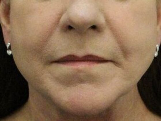 Non-Surgical: Case 11 - After