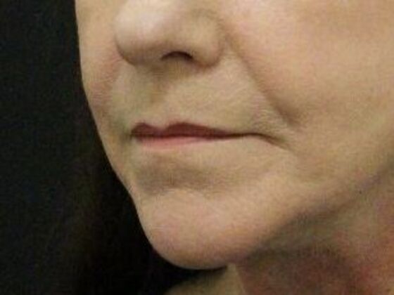 Non-Surgical: Case 11 - After