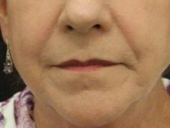 Non-Surgical: Case 11 - Before