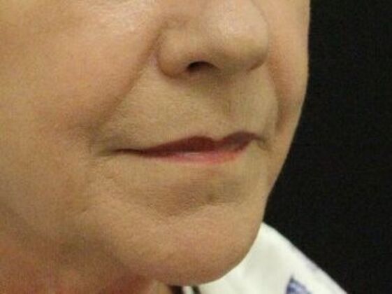 Non-Surgical: Case 11 - Before