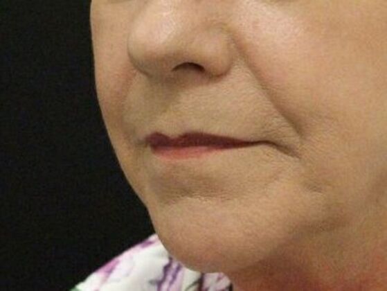 Non-Surgical: Case 11 - Before