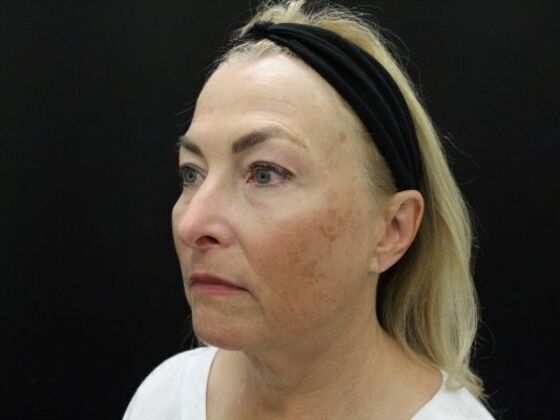 Face & Neck Lifts: Case 49 - Before