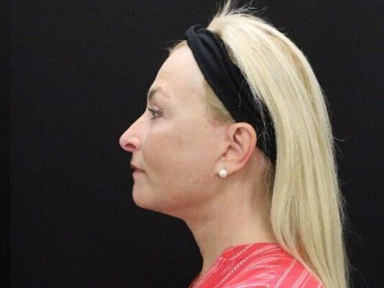 Face & Neck Lifts: Case 49 - After