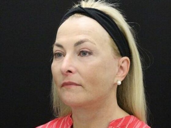 Face & Neck Lifts: Case 49 - After