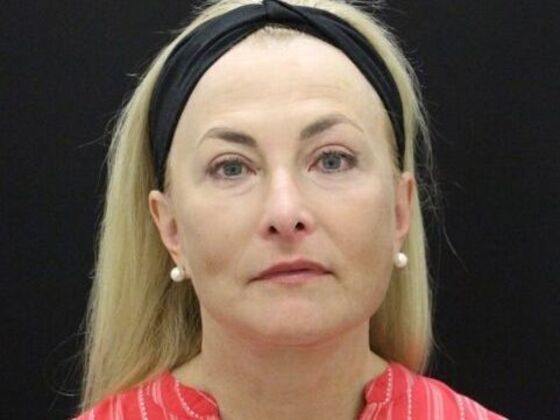 Face & Neck Lifts Case 49 - After