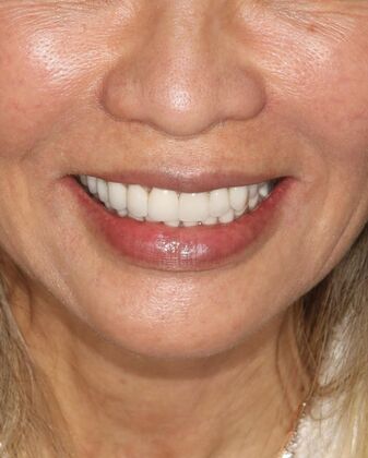 Porcelain Crowns Case 3 - After