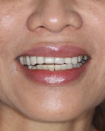 Porcelain Crowns Case 3 - Before