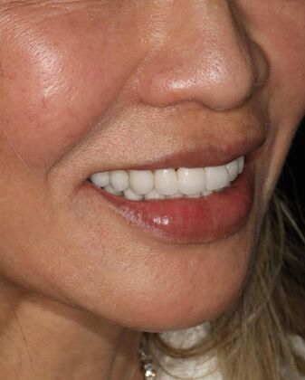 Porcelain Crowns: Case 3 - After