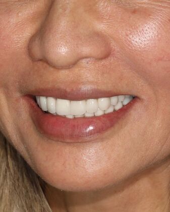 Porcelain Crowns: Case 3 - After