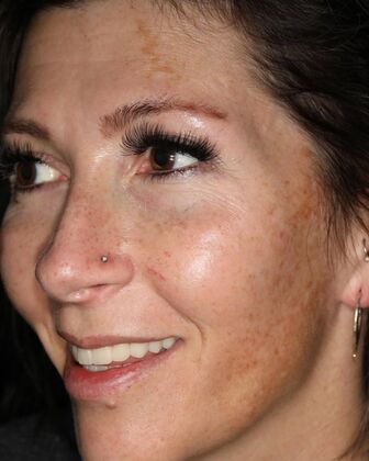 All-on-4 / All-on-X: Case 3 - After