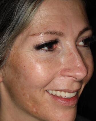 All-on-4 / All-on-X: Case 3 - After