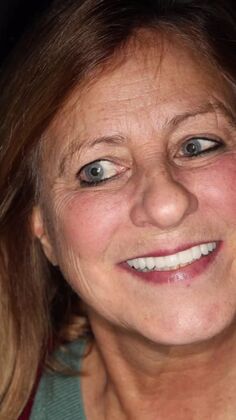 All-on-4 / All-on-X: Case 1 - After