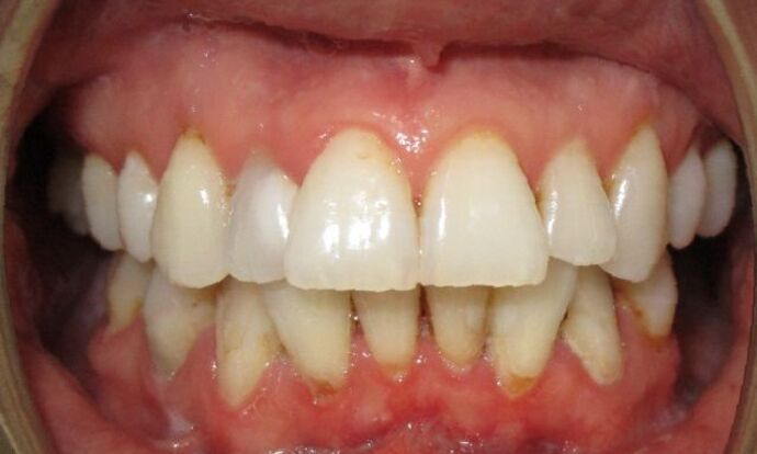 All-on-4 / All-on-X: Case 8 - Before