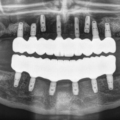 All-on-4 / All-on-X: Case 8 - After