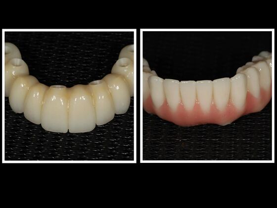 All-on-4 / All-on-X: Case 8 - After