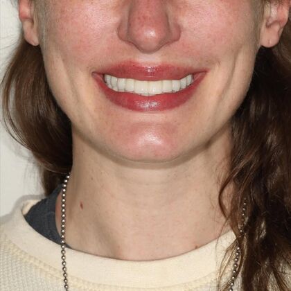 All-on-4 / All-on-X: Case 8 - After