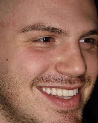 Porcelain Veneers Case 3 - After