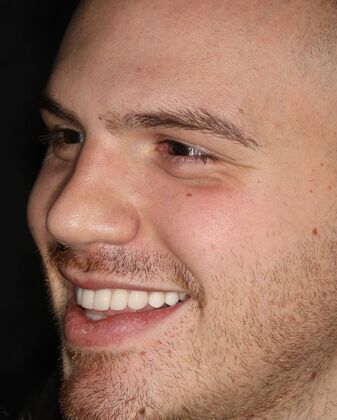 Porcelain Veneers: Case 3 - After