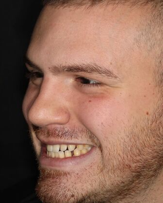 Porcelain Veneers: Case 3 - Before