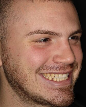 Porcelain Veneers Case 3 - Before