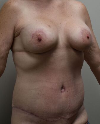 Mommy Makeover: Case 328 - After