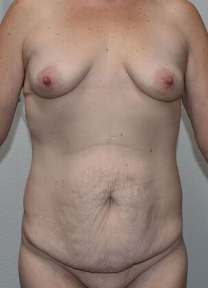 Massive Weight Loss : Case 164 - Before
