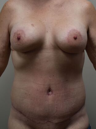 Massive Weight Loss : Case 164 - After