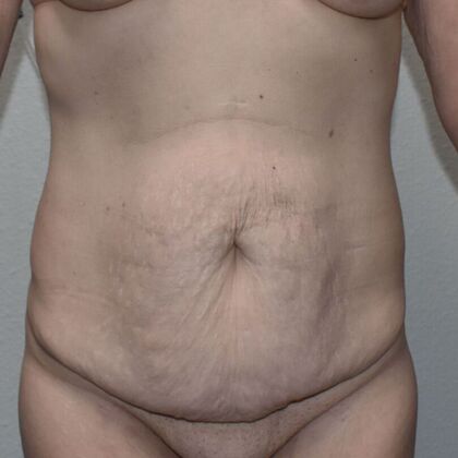 Tummy Tuck (Abdominoplasty): Case 516 - Before