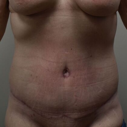 Tummy Tuck (Abdominoplasty): Case 516 - After